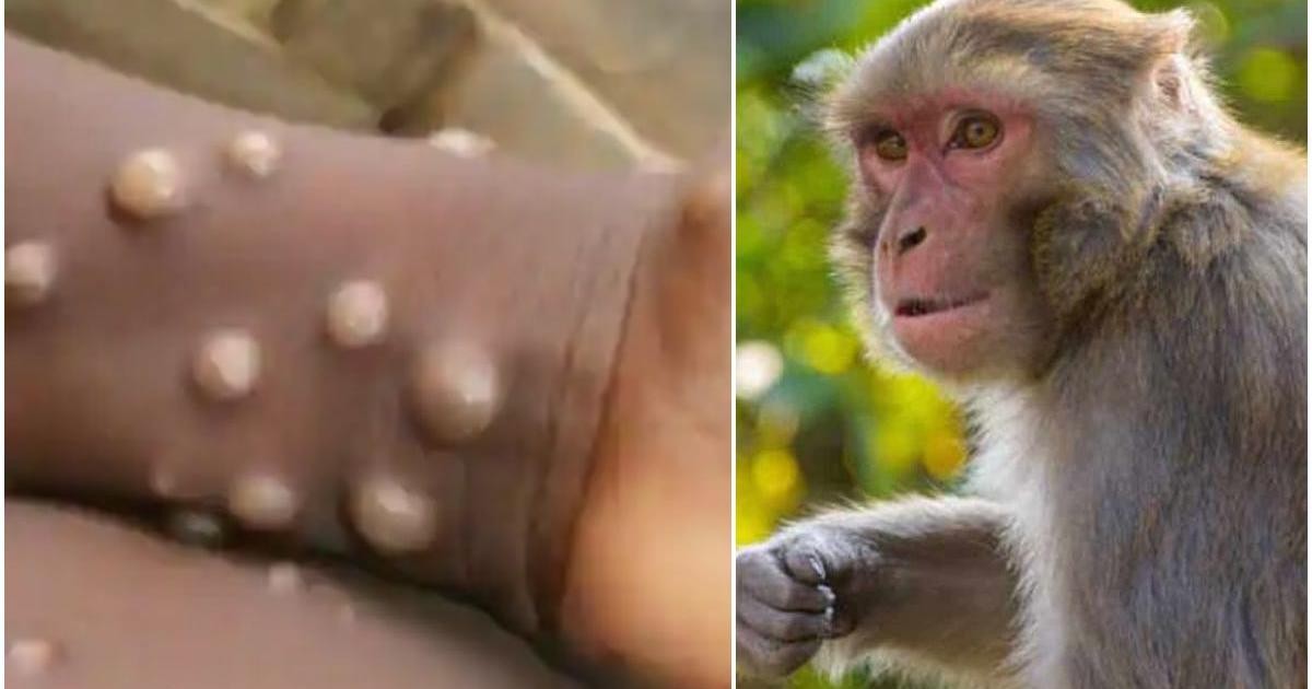 شناسایی مبتلایان جدید «آبله میمون» در سه کشور دیگر
